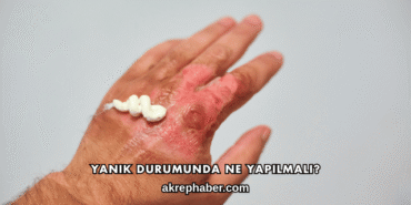 Yanık Durumunda Ne Yapılmalı?